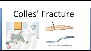 Orthopedics 130 Colles fracture Dorsal tilt Complications Dinner fork deformity Darrack Sudeck [upl. by Rutan]