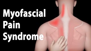 Myofascial Pain Syndrome and Trigger Points Treatments Animation [upl. by Hiamerej]