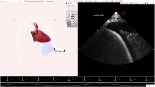 HeartWorks Pleural Effusion [upl. by Painter102]