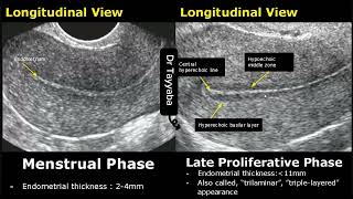 Endometrial Thickness Ultrasound Image Appearances  Endometrium Menstrual Cycle USG Images [upl. by Becky110]