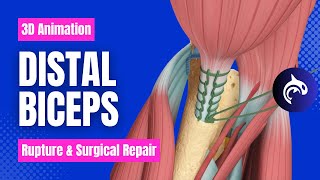 Distal Biceps Rupture and Surgical Repair  3D Animation [upl. by Vaenfila]