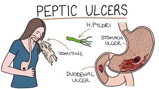 Understanding Stomach and Duodenal Ulcers [upl. by Terry919]