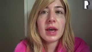 UPDATE Revision Rhinoplasty Video Diary  Day 15 After Surgery [upl. by Midge687]