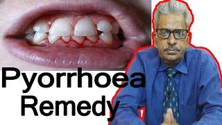 Pyorrhea  Discussion and Treatment in Homeopathy by Dr PS Tiwari [upl. by Ojeitak]