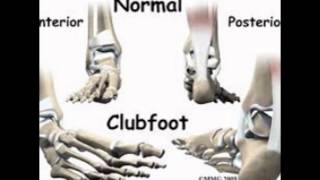 talipes equinovarus radiologyequinovarus talipestalipes equinovarus symptoms [upl. by Anallij]