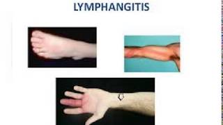 LYMPHANGITIS LEARN ABOUT PHLF [upl. by Eillat692]