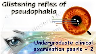 Glistening reflex in pseudophakia Undergraduate Clinical Examination Pearls 2 [upl. by Fen]