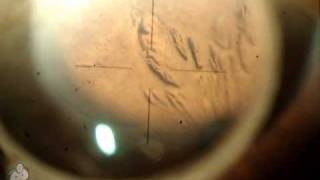 Laser peripheral iridotomy LPI [upl. by Susej]