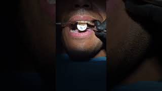 Examination of Dental Patient  Extreme CloseUp of a Dentist Examining a Patient [upl. by Alaaj]