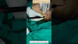 radiofrequency wart removalgenital wart condyloma shorts [upl. by Georgine]