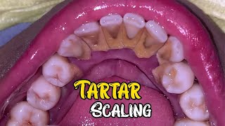 Deep Cleaning With HEAVY Tartar Build Up At The Dentist [upl. by Trocki778]