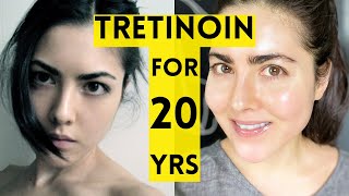 20 Year Results of Using Tretinoin [upl. by Elleinod]