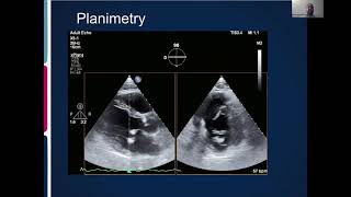 Joint Echo Conference Mitral Stenosis [upl. by Ayotal931]