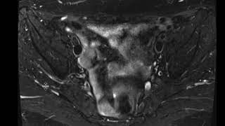 Recurrent endometrial cancer [upl. by Ardnek]