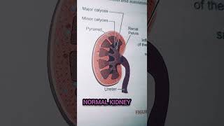 Normal kidney vs Glomerulonephritis medical biology kidney shorts gk yt shorts [upl. by Berri]