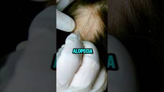 Di adiós a la alopecia 🌱AceiteDeBatana Alopecia BellezaNatural SaludCapilar [upl. by Llednohs]