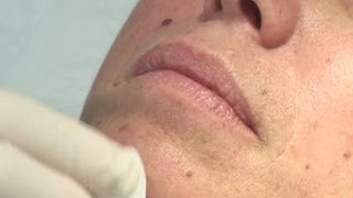 How To Remove Moles From Your Skin [upl. by Elohcim183]