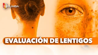 quotRevisión de Lentigos ¿Es Solo un Lentigoquot [upl. by Lydon433]