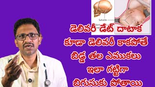 post dated pregnancy drkranthigynecologist డెలివరీ డేట్ తరువాత కూడా నొప్పులు రాకపోతే ఏమిఅవుతుంది [upl. by Einra672]