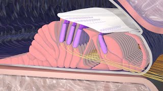 Hearing Loss Due to Nerve Damage [upl. by Dove]