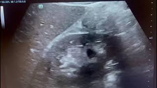 Angiomyolipoma in kidney on ultrasound radiologyViralcommonusgultrasoundrenalkidneydisease [upl. by Pettifer]