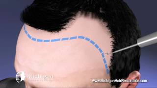 NeoGraft Michigan Hair Restoration 8444HAIRNOW [upl. by Orecic]