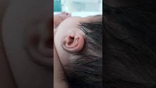 Case 266 neonatal hypertrichosis with infant of diabetic mother congenital hypothyroidism hairy [upl. by Sotsirhc]