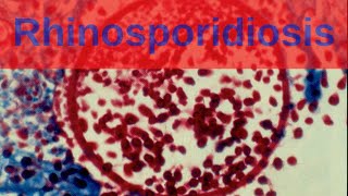 Rhinosporidiosis  Pathology mini tutorial [upl. by Uoliram]