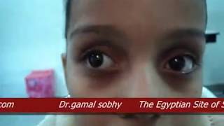 Intermittent Exotropia  الحول الوحشي المتقطع [upl. by Ecyak]