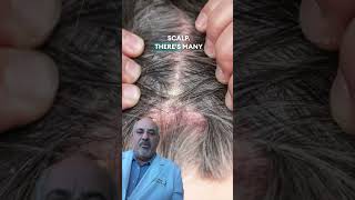 Scalp Flaking [upl. by Esac]