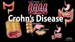 Crohns Disease Pathophysiology Symptoms Risk factors Diagnosis and Treatments Animation [upl. by Salomie783]