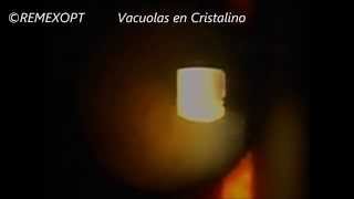 REMEXOPT Vacuolas en Cristalino [upl. by Ramalahs]