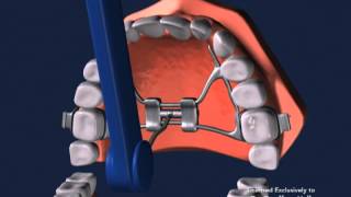 Advanced Orthodontics  Expanders [upl. by Yajnas]