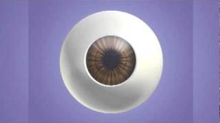 Astigmatic Keratoplasty AK [upl. by Nossaj351]