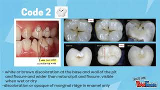 ICDAS and classification of caries [upl. by Letsirc]