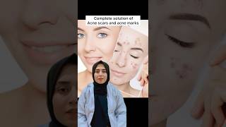 Solution of acne scars and acne marks  pimples  free medical advice Day11 skintreatment [upl. by Ahsilak157]