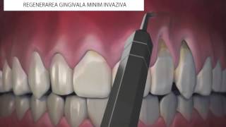 Regenerare gingivala minim invaziva [upl. by Ynaffyt]