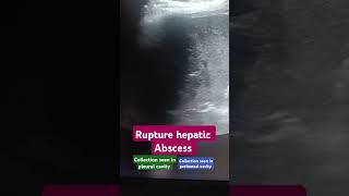 Ruptured Liver abscess usg3d usg hepatic infection radiology emergency phonk halloween [upl. by Nnadroj]