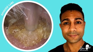 1485  Masses of Dead Skin Removed from Both Ears  Learn About Different Ear Wax Drops [upl. by Reena]