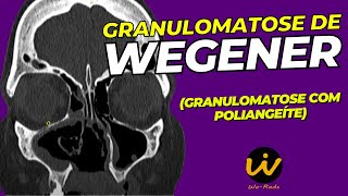 GRANULOMATOSE de WEGENER  Granulomatose com Poliangeíte [upl. by Anemolihp]