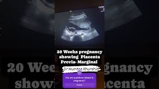 20 Weeks Pregnancy showing Placenta Previa On Ultrasound [upl. by Ahsinoj18]