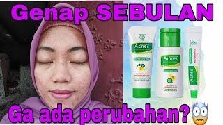 SEBULAN PAKAI ACNES INI KONDISI MUKA AKU [upl. by Attenborough]