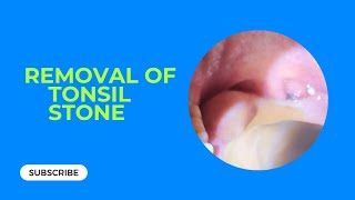 Removal of Tonsil stone  টনসিল স্টোন অপসারণटॉन्सिल स्टोन का इलाज [upl. by Aiseneg]