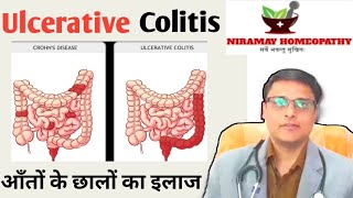 Ulcerative colitis symptomsdiettreatment  Ulcerative colitis homeopathy [upl. by Ahsitauq]