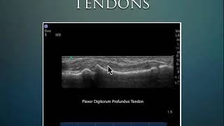 MSK Ultrasound tendon joints [upl. by Ailemac]