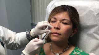 Juvederm Vollure Injection Treatment [upl. by Reinar]