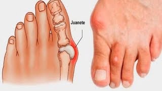 Vendaje para Juanete o hallux valgus ojo de pescado [upl. by Laamaj83]