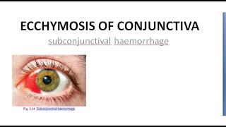 Ophthalmology Ecchymosis of Conjunctiva SubConjunctival Hemorrhage Blood red eye [upl. by Chrysa212]