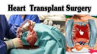 Heart Transplant Procedure Causes amp Recovery  3D Animation [upl. by Aihsile]