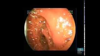 ERCP with BalloonAssisted Enteroscope in Patients with Surgically Altered Upper GI Anatomy [upl. by Shaver101]